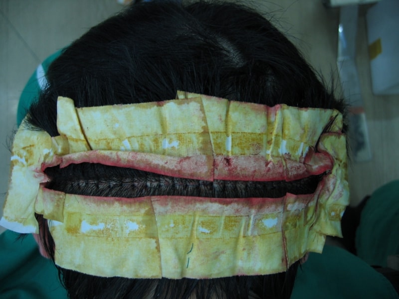 10) 다모 절개 직후 뒷머리 사진.JPG
