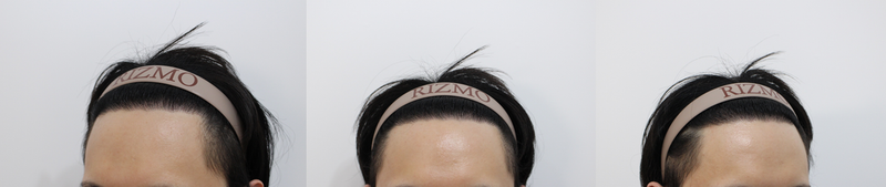 3. 수술 후8개월 경과.png
