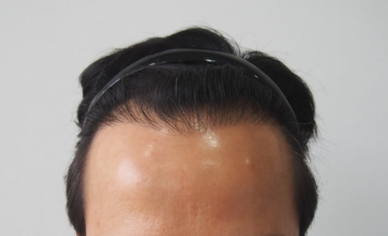 수술전_정면.jpg