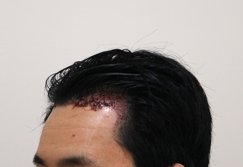 2. 수술후_1일_2.JPG
