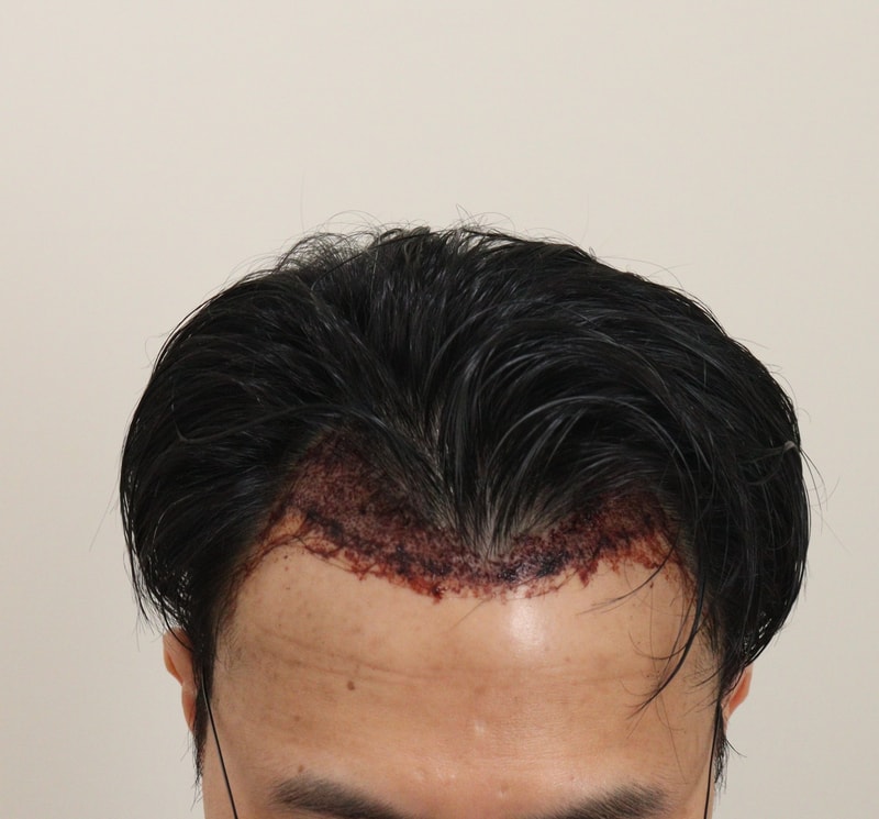 2. 수술후_1일.JPG