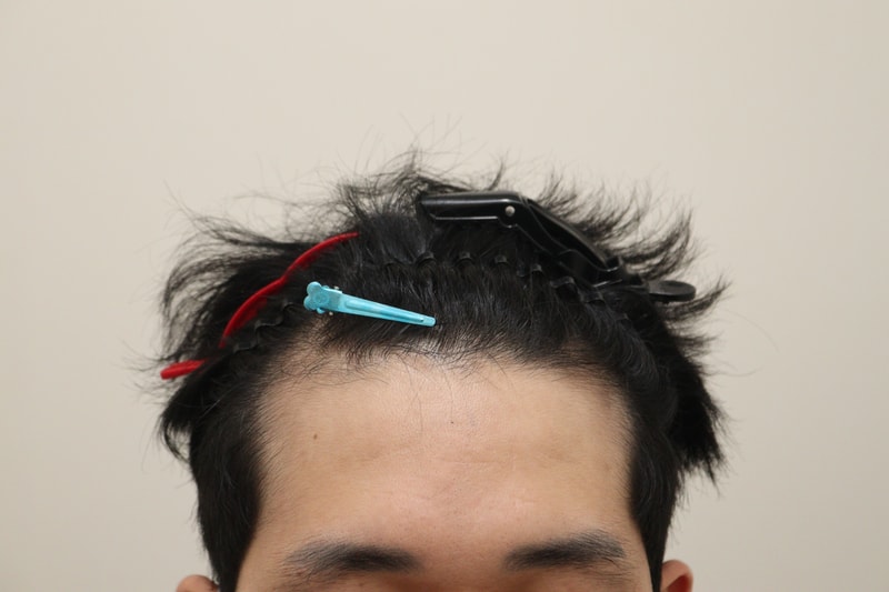 1. 수술전_1.JPG