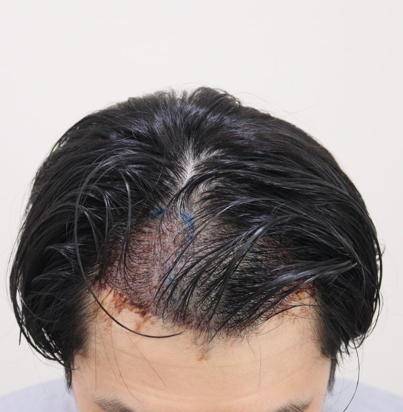 2. 수술후_1일_2.JPG