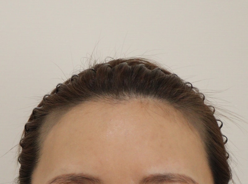 It's been 3 months since my Hair Transplant.