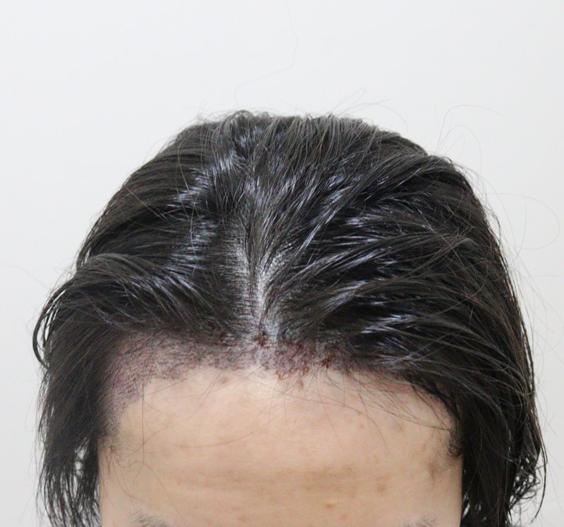 2. 수술후_1일_2.JPG