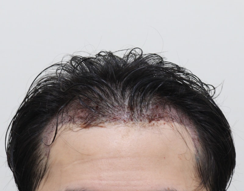 2. 수술후_1일_1.JPG