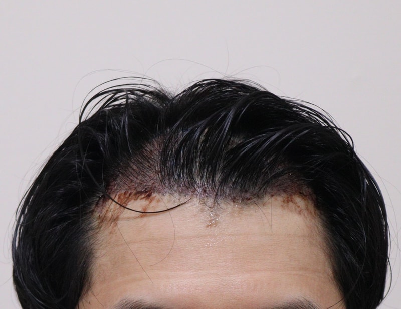 2. 수술후_1일_1.JPG