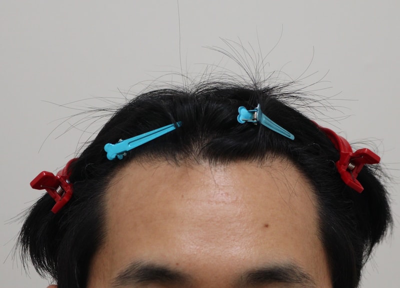 1. 수술전_1.JPG