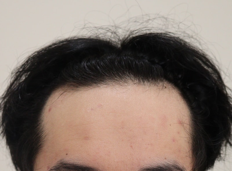 It's the 3rd month of Hair Transplant.