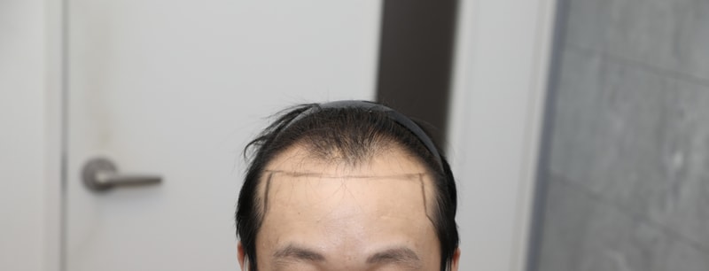 New hair 2500 follicle incision