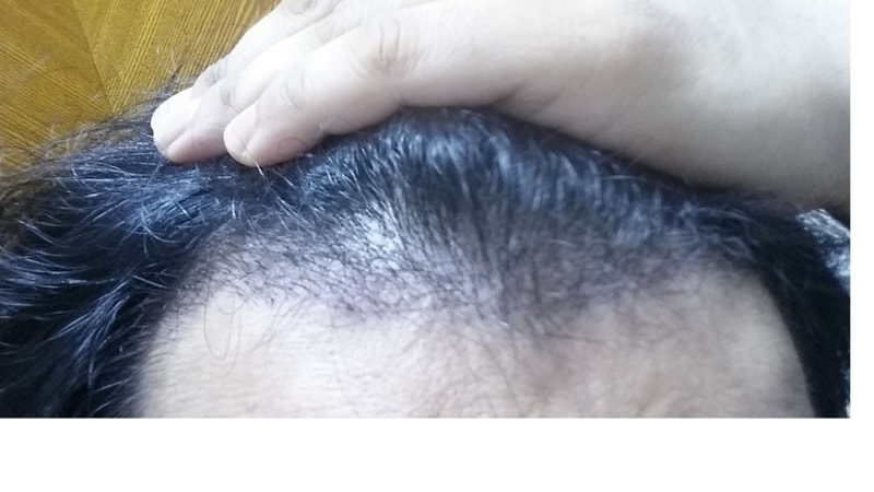 수술후17일.png