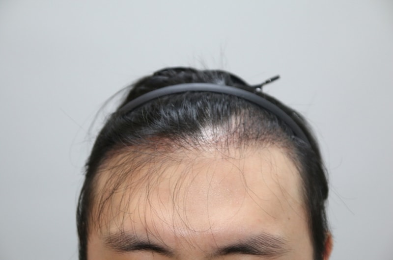 부분삭발 1200모낭 생존신고하러 왔습니다ㅎ