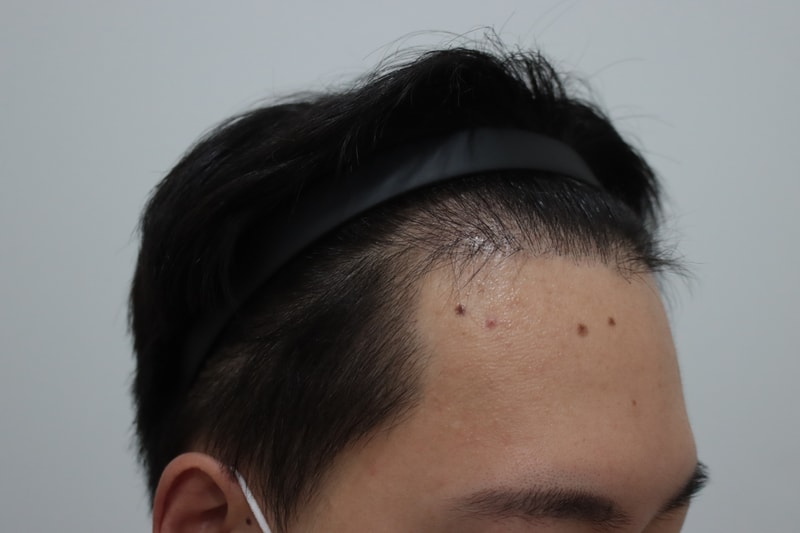 모발이식 5개월차 사진입니다