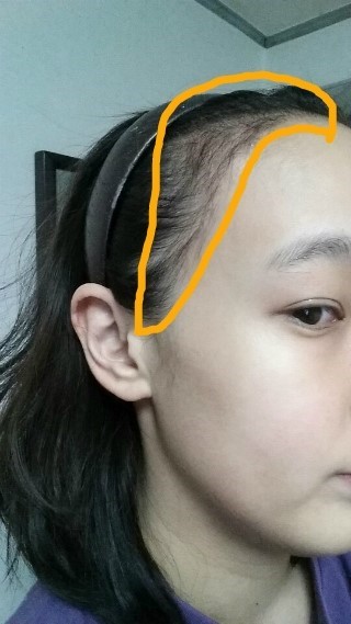헤어라인2달.JPG