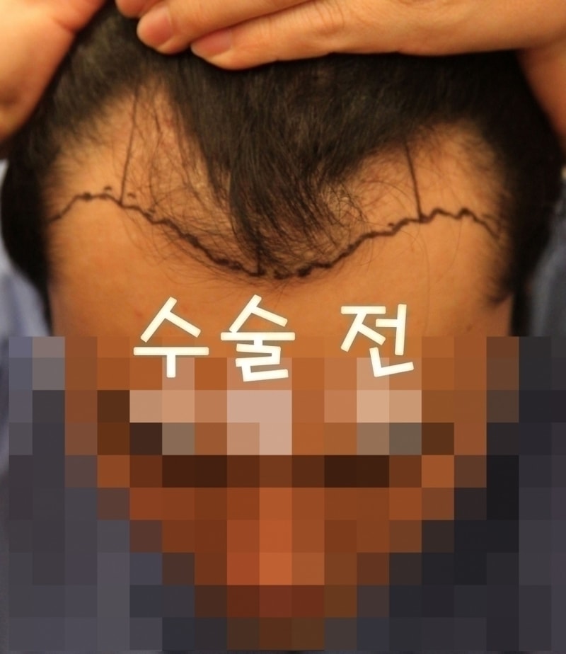 -수술전.jpg