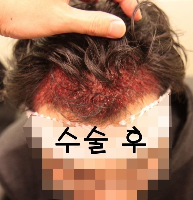 -수술 후.jpg