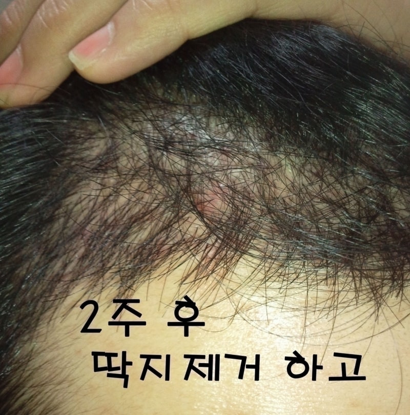2주(딱지제거).jpg