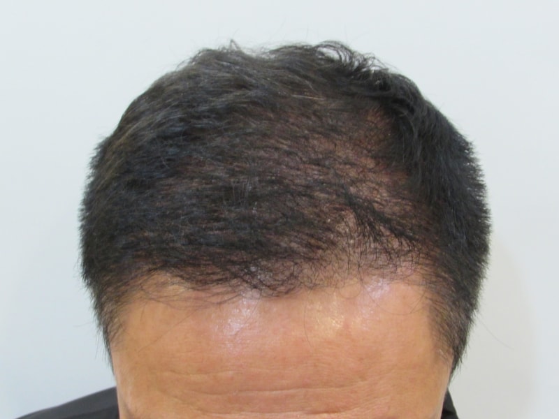 수술 후 앞 위.JPG