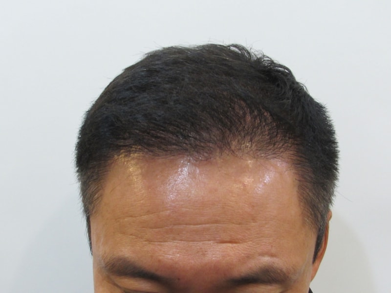 수술 후 1년 앞.JPG