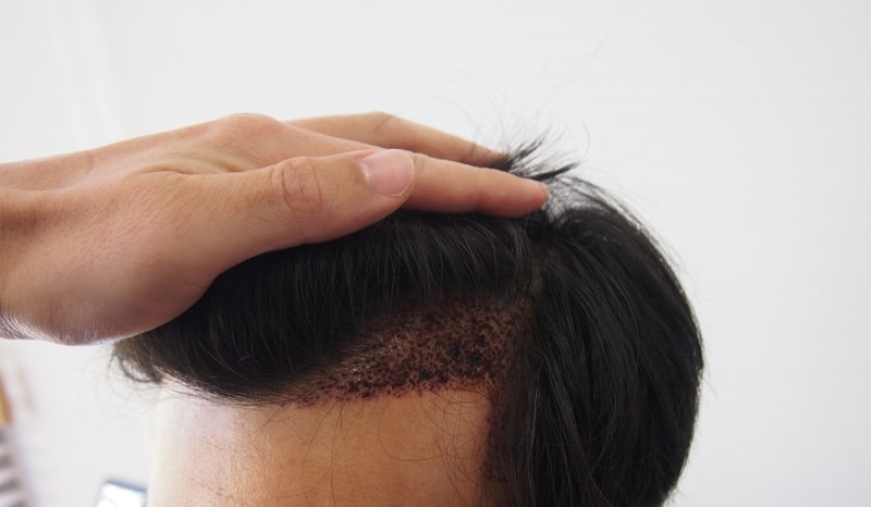 It's a review of 1300 hair follicle non-excision