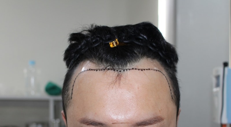 수술전2.jpg