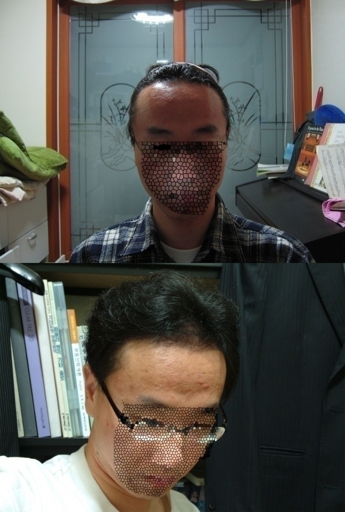 수술전 copy.jpg