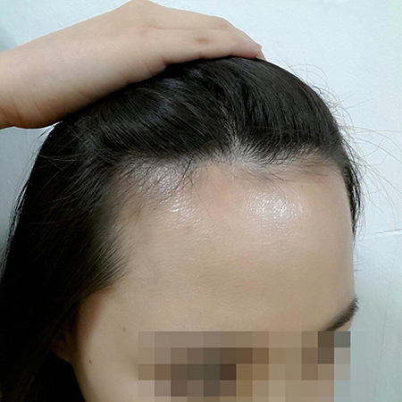 드디어 헤어라인교정 총 1년 됐어요~