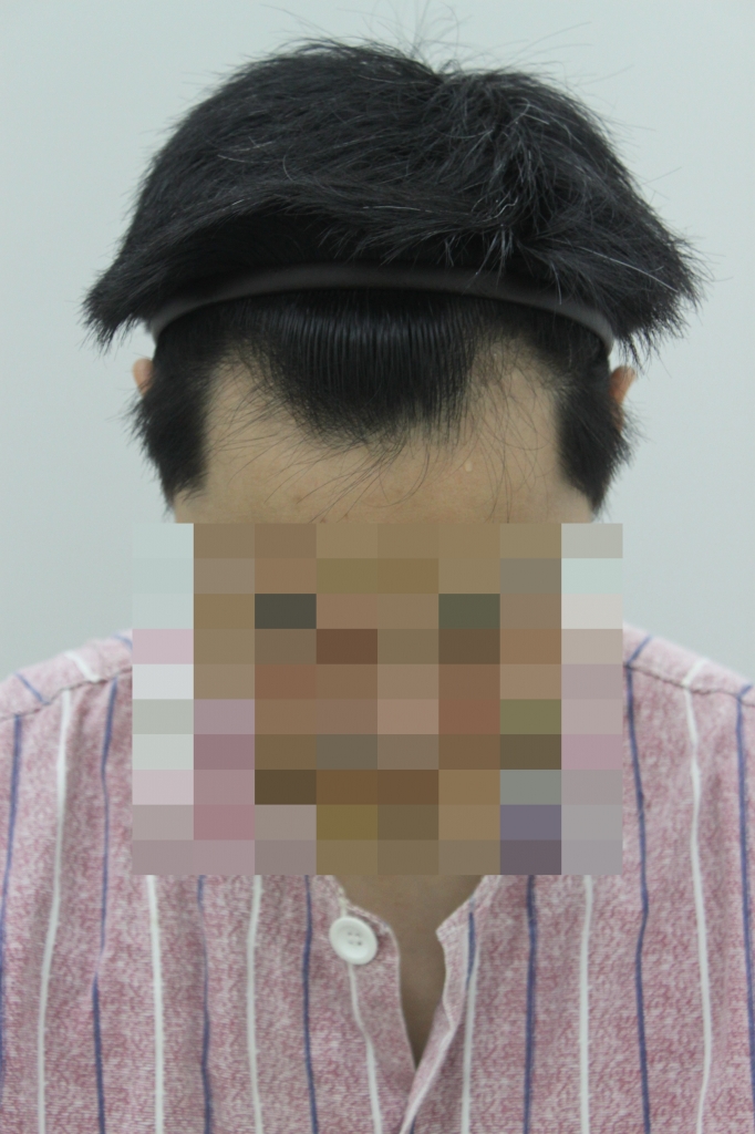 2년간 고민한 무삭발 비절개 C2G 1200모낭 후기