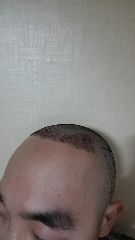 포헤어에서 1500모낭 모발이식