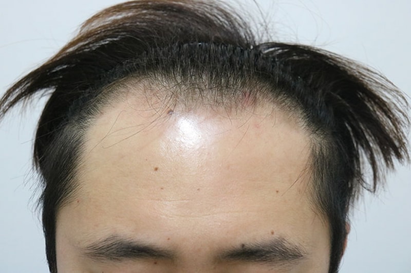 절개 3500모 6개월 득모 후기