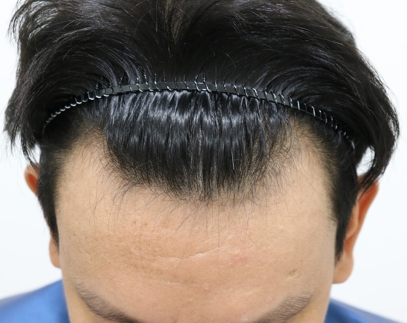 절개 3500모 이식받고 6개월 (맥도날드M 사라짐)