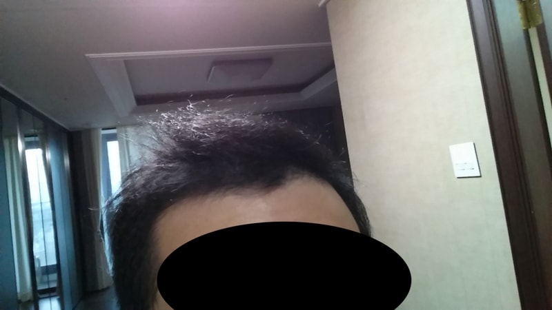 뉴헤어 M자 모발이식 후 득모중입니다.