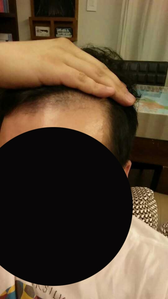 수술후 1개월.jpg