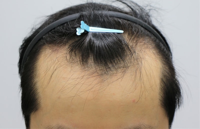 Forehead Seoul Branch Hair Transplantation in 9 Months