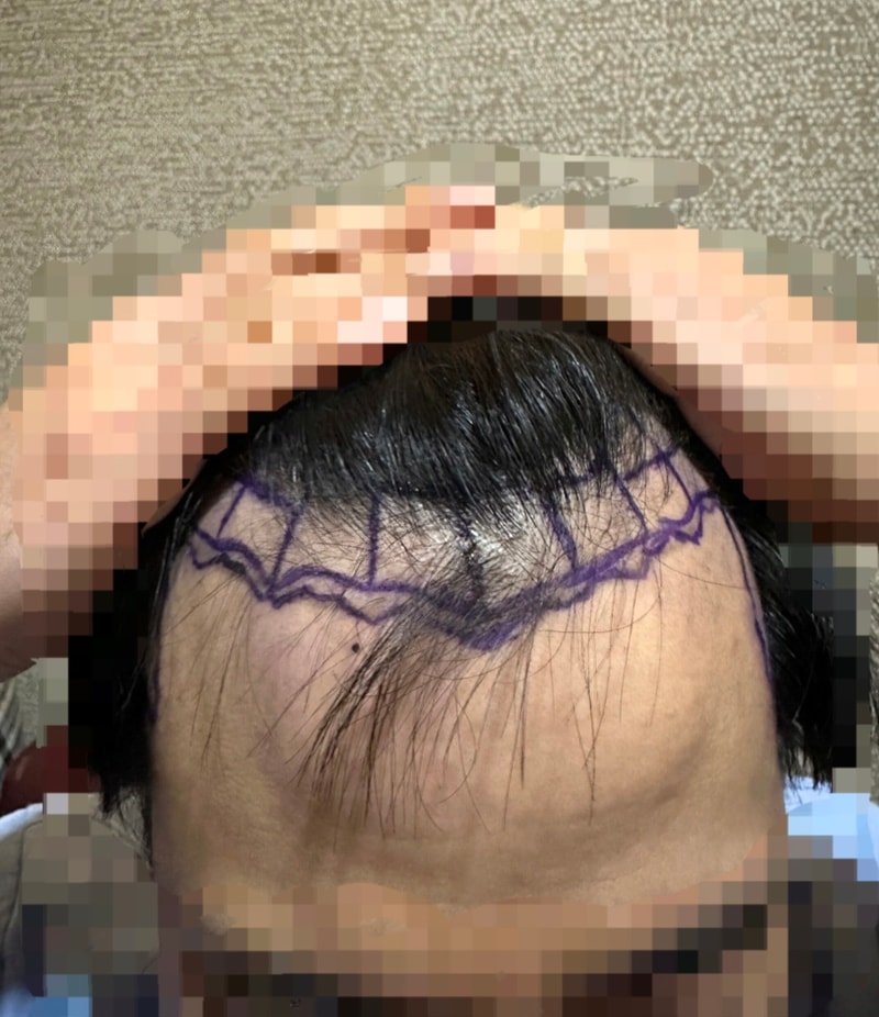 정면[수술전].jpg