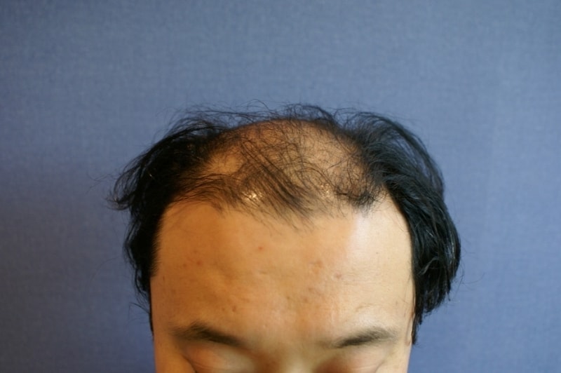 2011년 이식 당시 사진입니다.