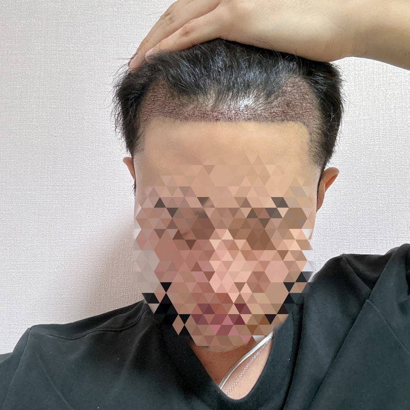 수술익일.jpeg