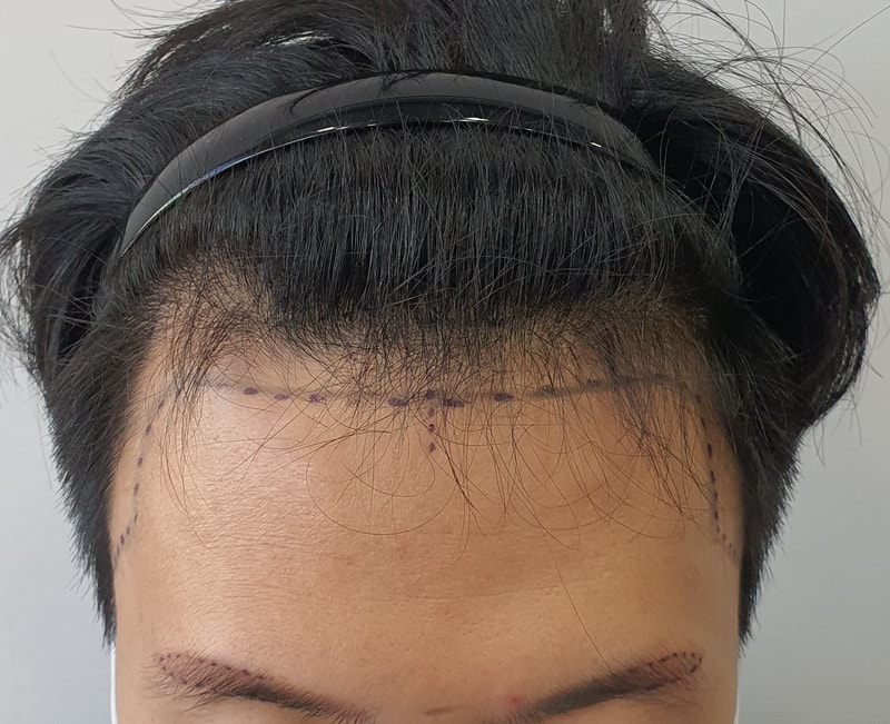 I had surgery on 1/4.