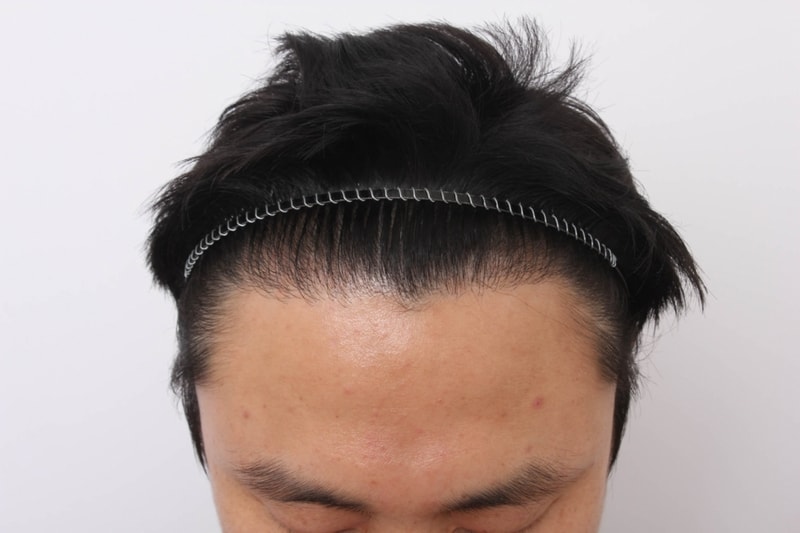 9개월경과-4.jpg
