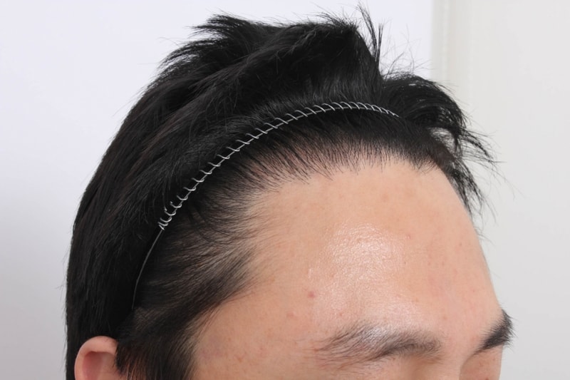 9개월경과-3.jpg