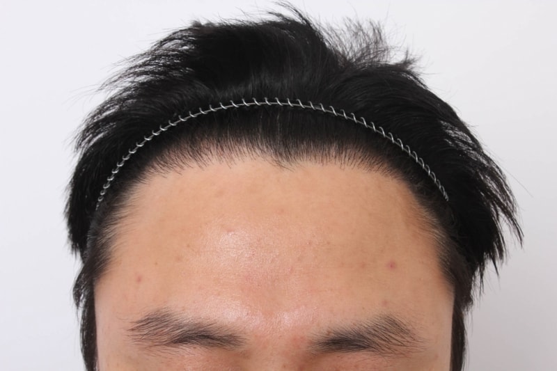 9개월경과-1.jpg
