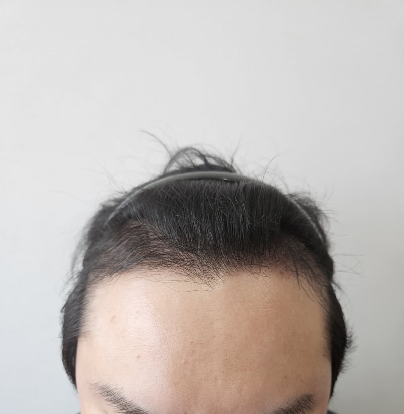 Post-mortem Non-Cutting of Parental Plastic Surgery