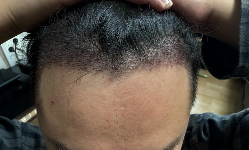 Post-mortem of the 14th day of non-intersection of the parent plastic surgery surgery