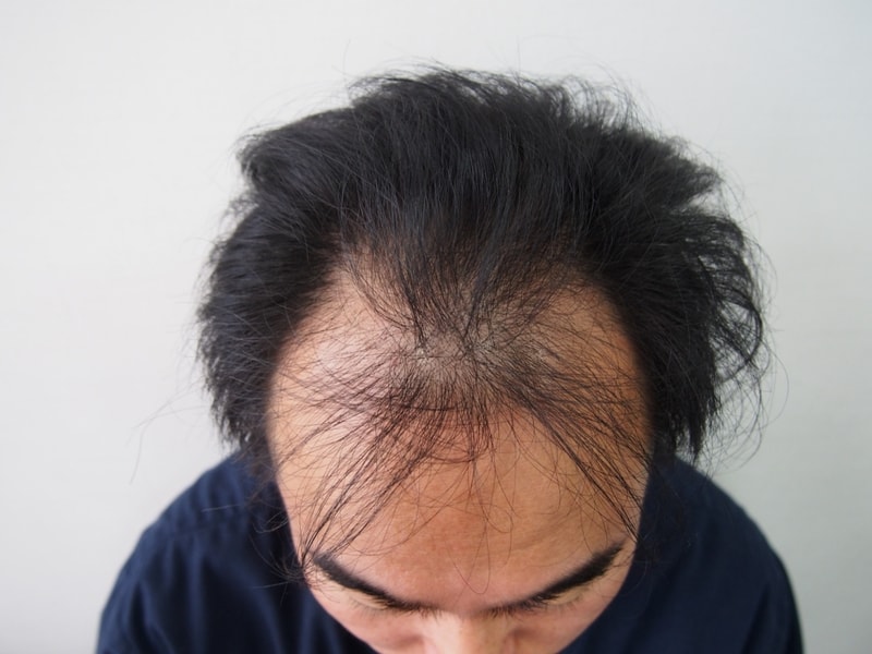 수술한지 3개월 하고 20일 좀 넘었습니다^^..