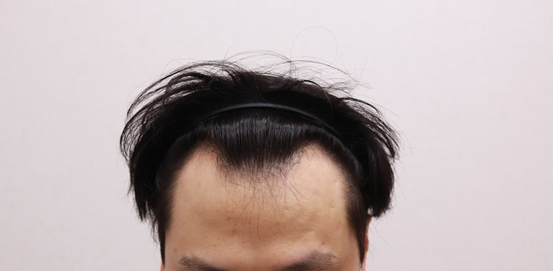 수술하기전.JPG