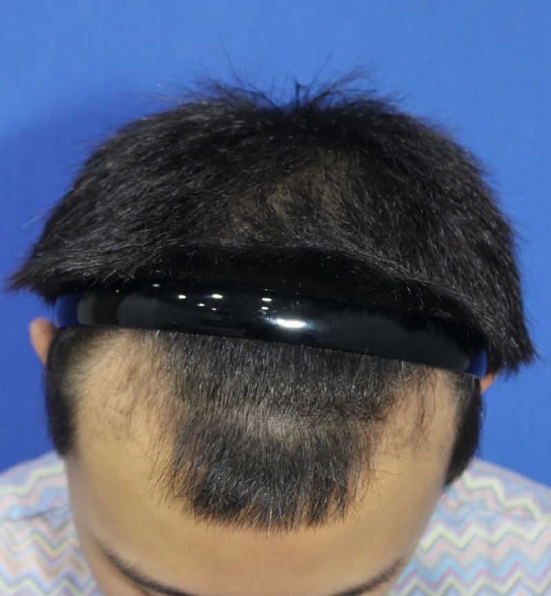 2.수술전.jpg