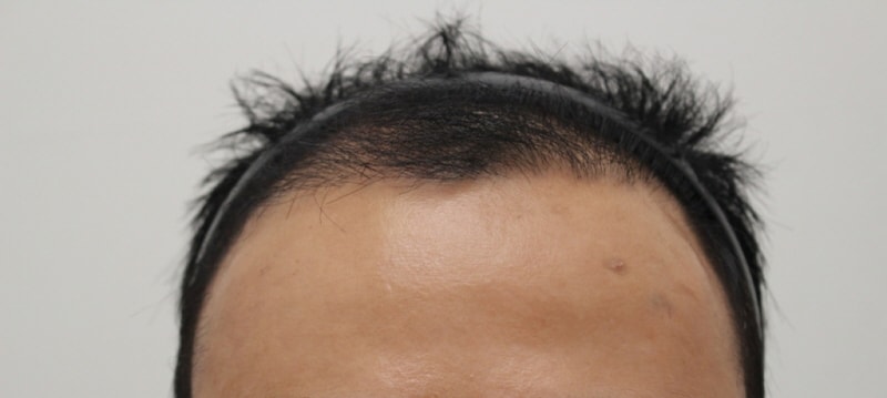 8.수술3개월차.jpg