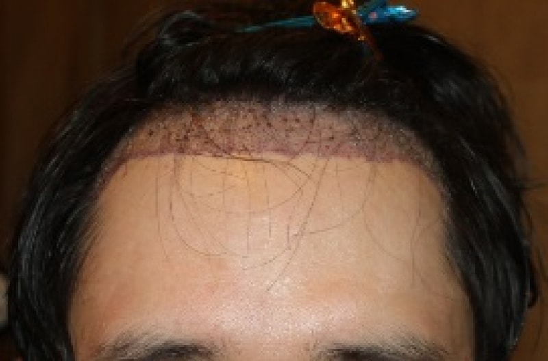 수술다음날 샴프한 후.jpg