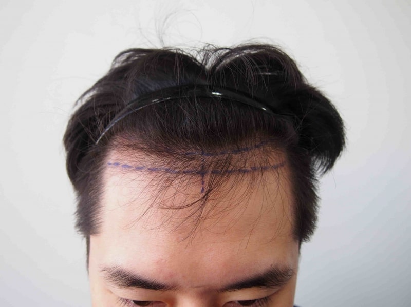 수술전 1.JPG
