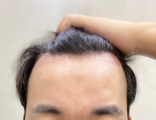 포헤어 수술 후 2개월차... 지옥의 암흑기 시작